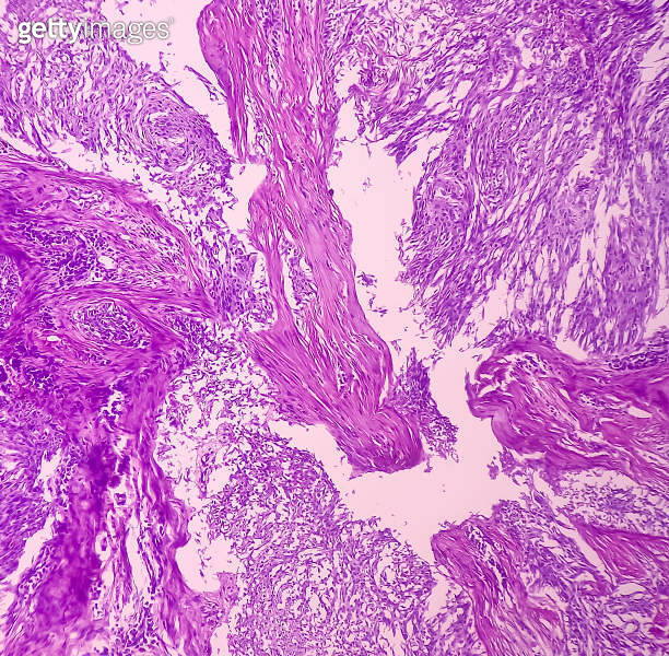 Nipple (biopsy) Invasive squamous cell carcinoma of nipple