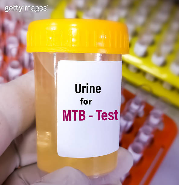 Urine sample for Genexpert (MTB) test in PCR laboratory, to diagnoses