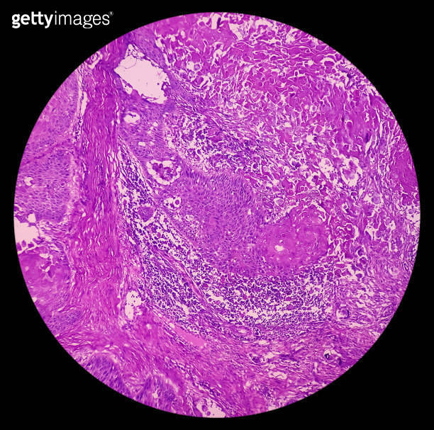 Nipple (biopsy) Invasive squamous cell carcinoma of nipple