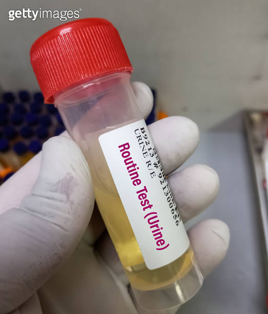 Medical technologist holding urine sample for routine examination or RE