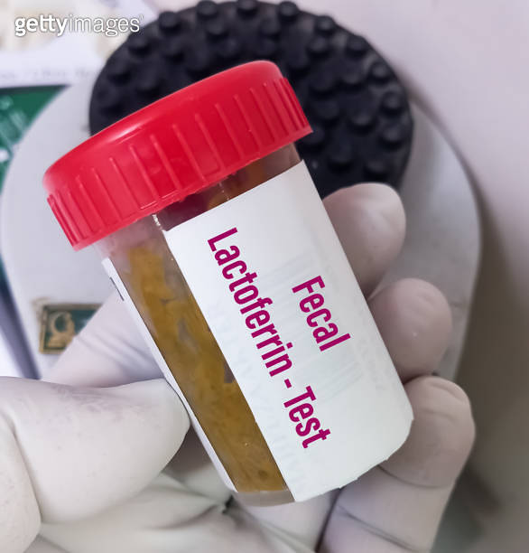 Stool sample for Lactoferrin Test, to screen for inflammatory bowel