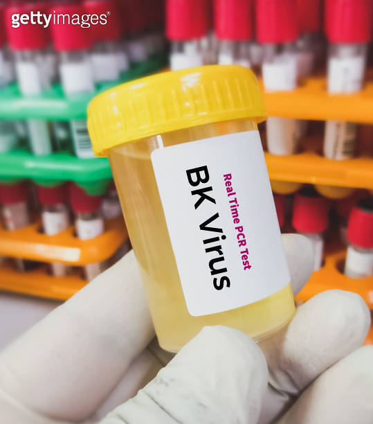 Urine sample for Real time PCR BK virus test, 이미지 (1759709951) 게티이미지뱅크