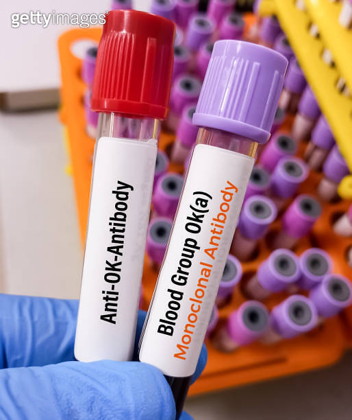 Technician hold blood sample for OKa blood grouping test or AntiOK