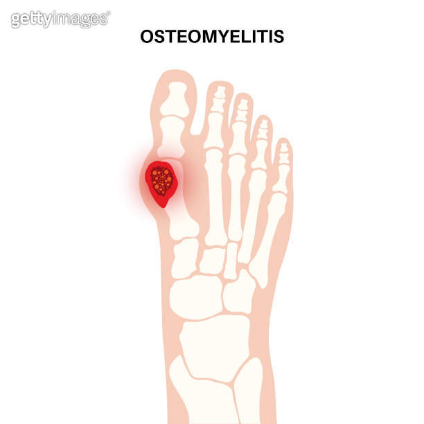 Osteomyelitis of feet 이미지 (1706986712) 게티이미지뱅크