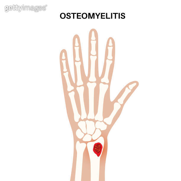 Osteomyelitis of arm 이미지 (1714025082) - 게티이미지뱅크