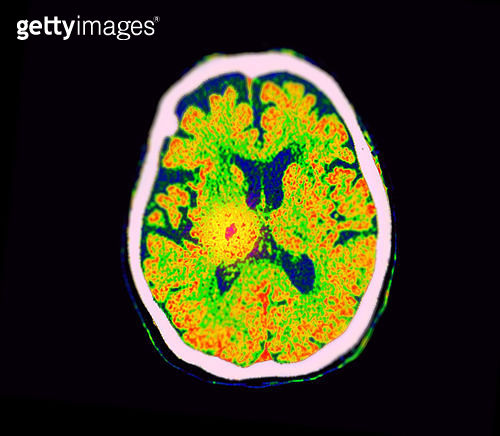 CT Brain Perfusion or CT scan image of the brain axial view showing ...