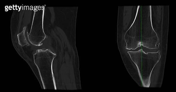 CT Scan of Knee joint sagittal and coronal in case fracture patella ...