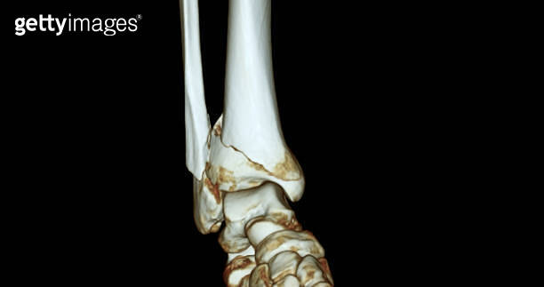 CT Scan ankle joint 3D Rendering image showing fracture tibia and ...