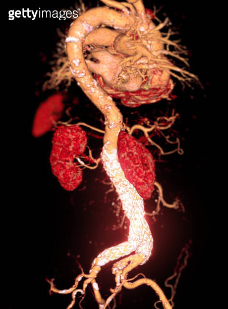 CTA whole aorta with Abdominal aorta stent graft 3D rendering image in ...