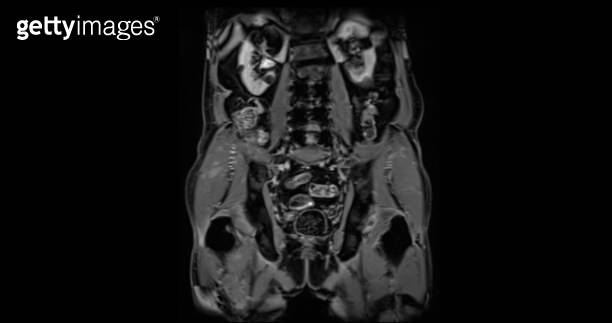 Prostate Coronal View MRI prostate gland coronal T2W for diagnosis prostate cancer cell in ...