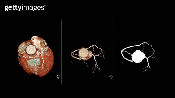 CT Cardiac 3D rendering or CTA coronary artery for prevention coronary ...