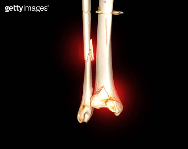 CT Scan ankle joint 3D Rendering image showing fracture tibia and ...