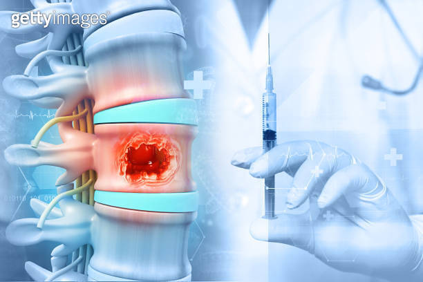 lumbar spine injection. Backbone or spinal column treatment with ...