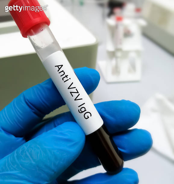 Blood sample for Anti varicellazoster virus (VZV) IgG test. 이미지
