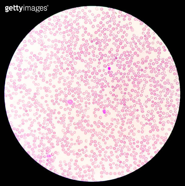 Microscopic blood picture showing chronic anemia. iron deficiency