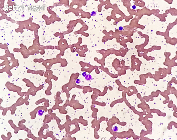 Thrombocytosis blood smear showing abnormal high volume of platelet ...