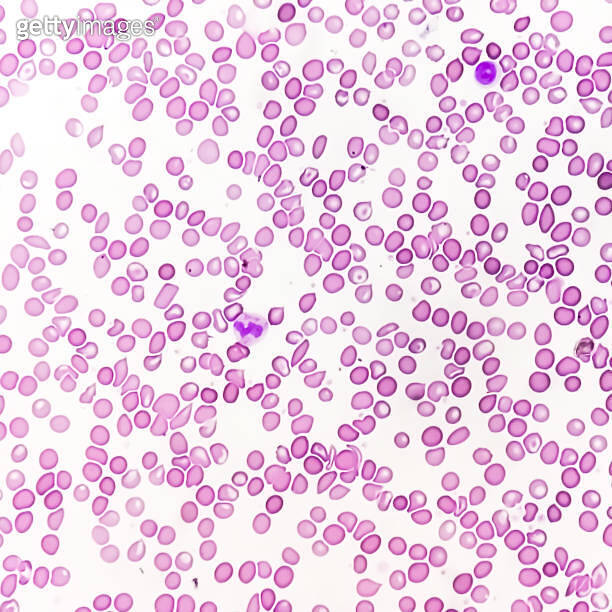 Microscopic blood picture showing chronic anemia. iron deficiency