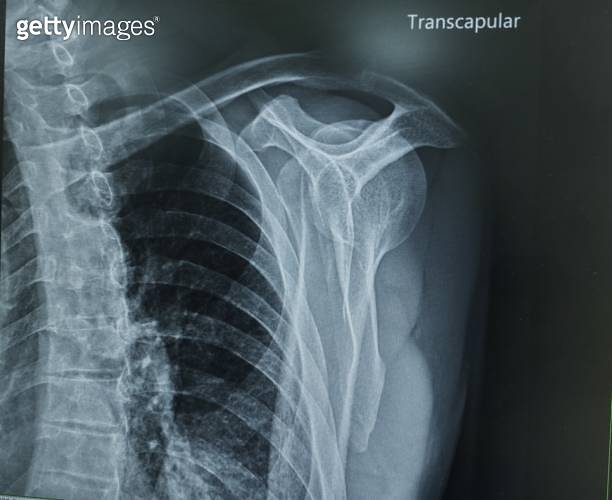 Xray shoulder joint 이미지 (1632665548) 게티이미지뱅크