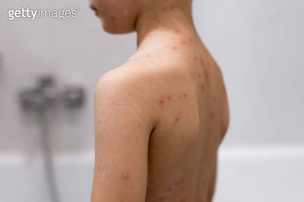 Boy Rash Back Boy with chickenpox. Rash on child body close up (1975029805) - 게티이미지뱅크