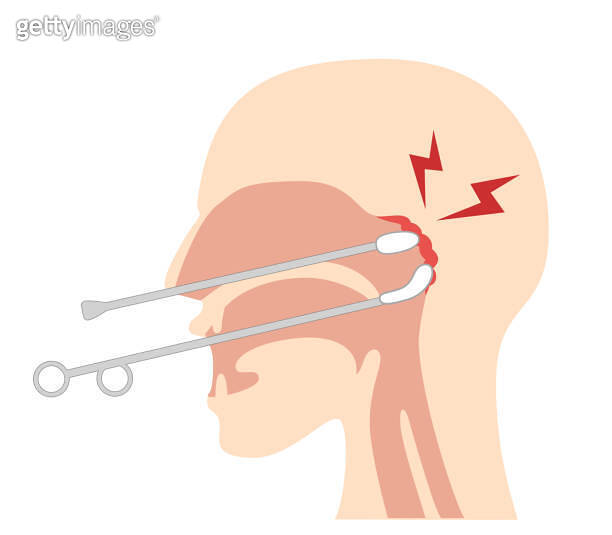 How to perform and illustrate Epipharyngeal Abrasive Therapy;Bspot