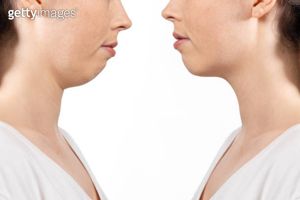 Overbite dental occlusion. Woman’s face before and after correction of