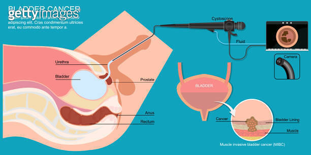 Cystoscopy enables the inside of the urethra and bladder to be examined ...