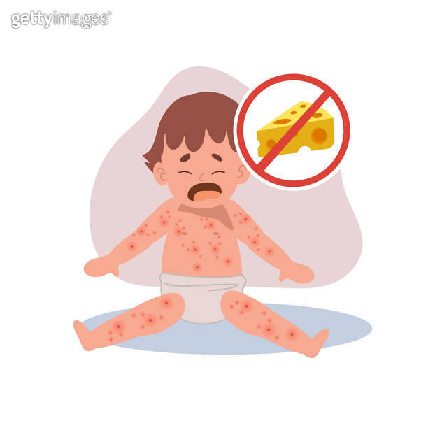 Allergic Reactions in Infants. baby with skin rash. Baby Food Allergy