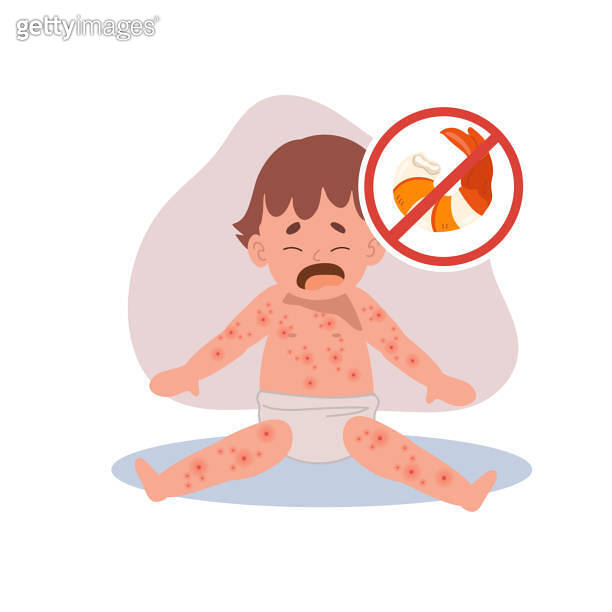 Allergic Reactions in Infants. baby with skin rash. Baby Food Allergy