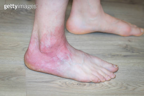 acute allergy, swollen and red foot, allergic reaction, itchy skin ...