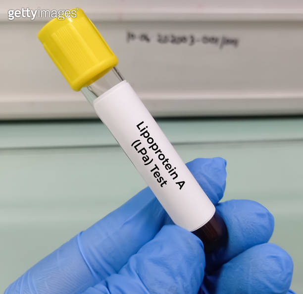 Blood sample for lipoprotein A (LpA) test. Lipid profile. to diagnosis of high risk for heart