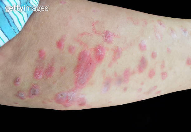 A raised, red, target like rash on the skin or mucous membranes ...