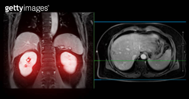PET MRI of the liver in liver cancer provides precise imaging, aiding ...