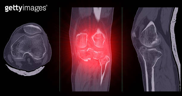 CT Imaging of Tibia and Fibula Fracture in Trauma Case A detailed CT ...