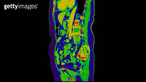 CT scan of Abdomen sagittal view with injection contrast media with ...