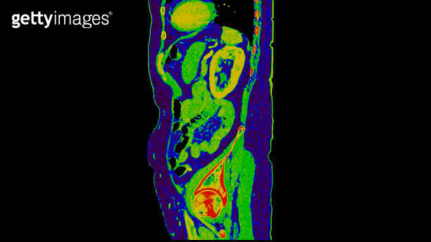 CT scan of Abdomen sagittal view with injection contrast media with ...