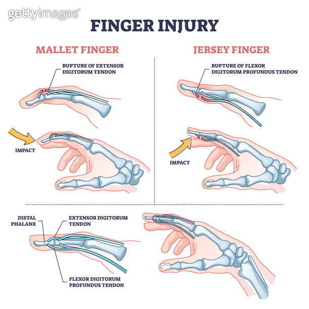 Finger injury types with common hand impact trauma anatomy outline ...