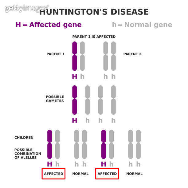 Huntington's disease Autosomal dominant inheritance. 이미지