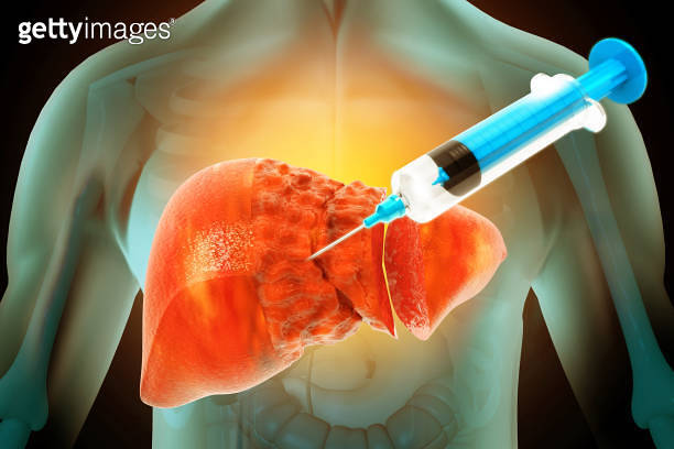 Liver disease, diagnosis and treatment, Injection, Drug Method ...