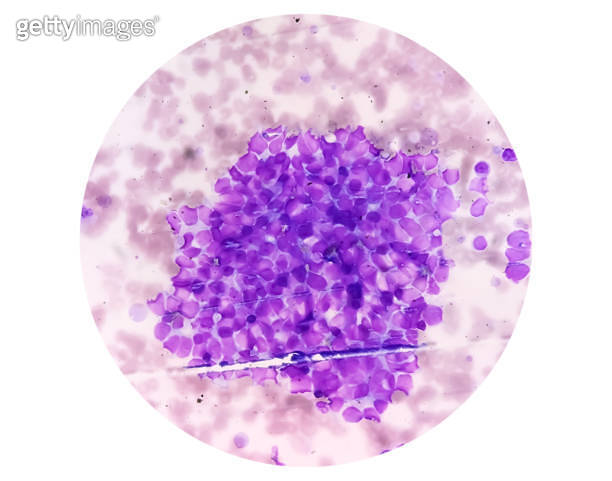 Blood cancer. Photomicrograph of Acute Leukemia, a cancer of white ...