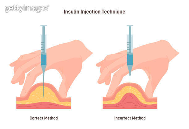 Insulin injection technique. Correct and incorrect way. Cross-section ...