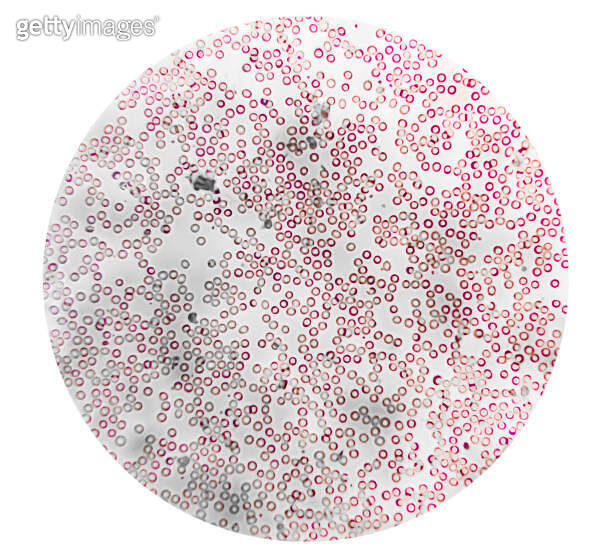 Human blood under a microscope. You can see erythrocytes - red blood ...